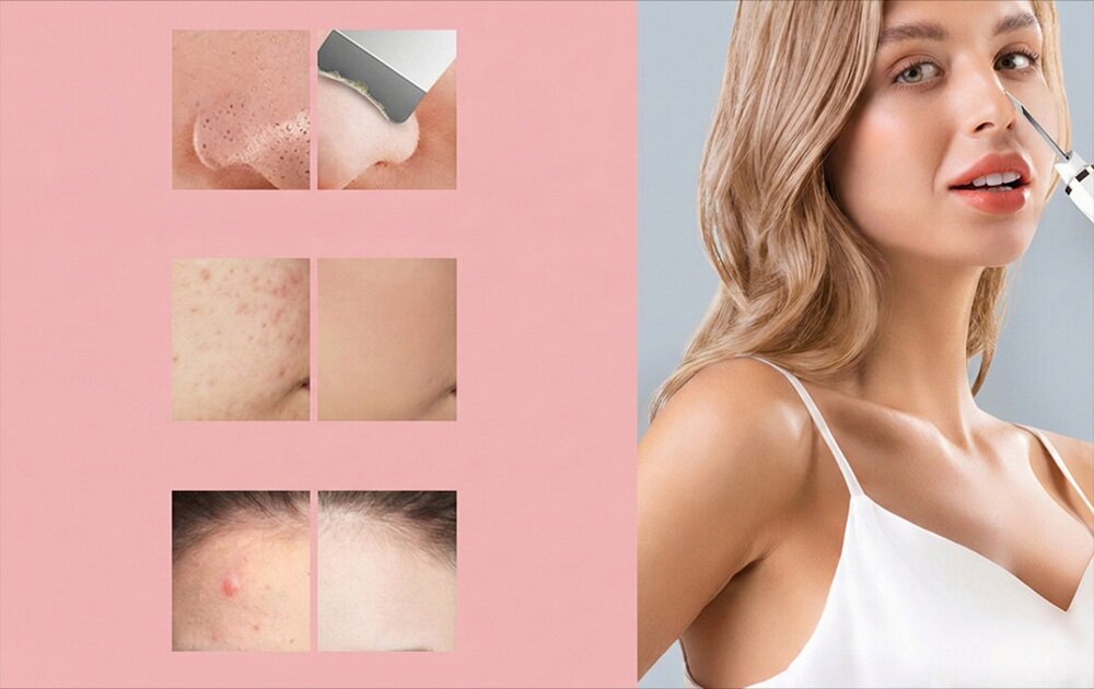 Urządzenie do peelingu kawitacyjnego EXTRALINK Ultrasonic Skin Cleaner 3w1 28 kHz mikroprądy ems, poprawa napięcia, ujędrninie skóry