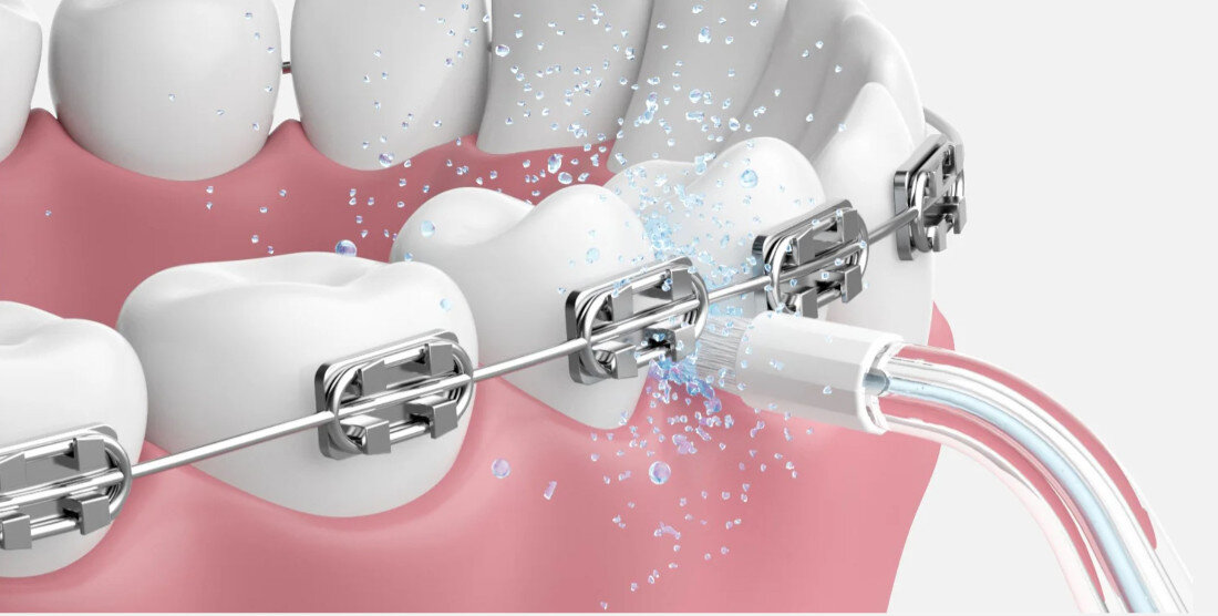 Oryginalna końcówka do irygatora OCLEAN A10 (2 szt.) (Dokładna higiena jamy ustnej) oczyszczanie jamy ustnej pod optymalnym kątem skuteczne usuwanie resztek jedzenia, bakterii oraz osadu zdrowe dziąsła i świeży oddech
