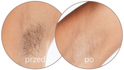 Obraz przedstawia dwa okrągłe zdjęcia porównawcze skóry pod pachą z podpisami \'przed\' i \'po\'. Na zdjęciu \'przed\' widoczne są włosy, a na zdjęciu \'po\' skóra jest gładka.