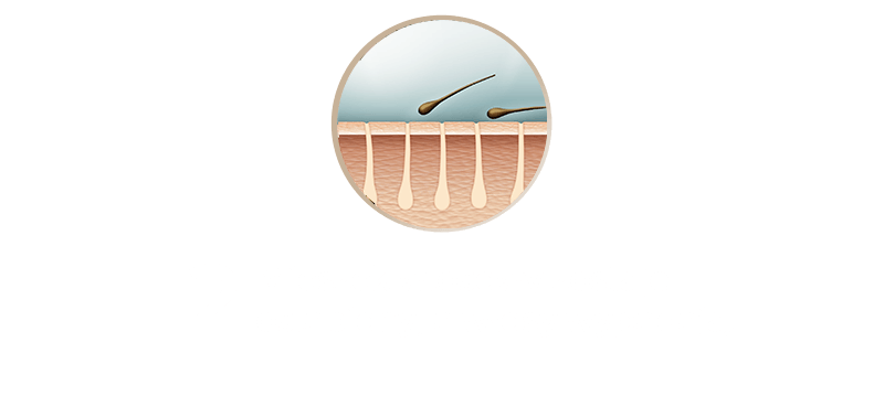 Ilustracja przedstawia przekrój skóry z mieszkami włosowymi, z których wypadają włosy. Pod spodem znajduje się tekst: \'2 Mieszek włosowy zostaje osłabiony, a włosy wypadają.\'.