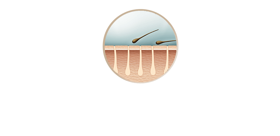 Ilustracja przedstawia przekrój skóry z mieszkami włosowymi, z których wypadają włosy. Pod spodem znajduje się tekst: \'2 Mieszek włosowy zostaje osłabiony, a włosy wypadają.\'