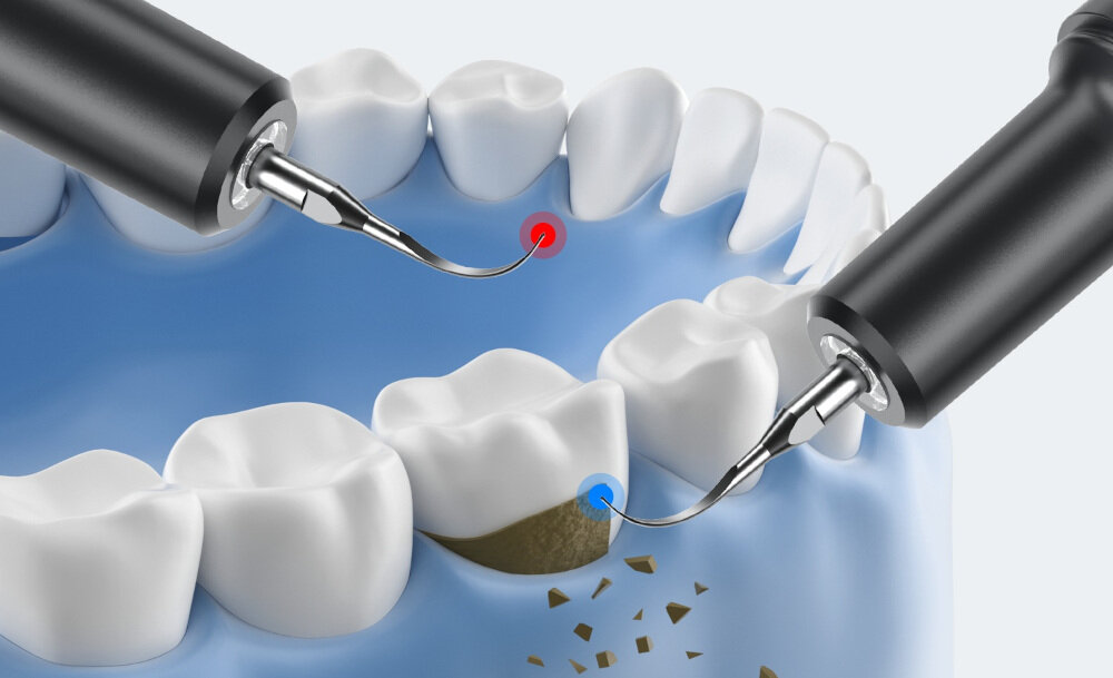 Skaler do zębów EXTRALINK Ultradźwiękowy CS-01 Precyzyjne usuwanie osadów usuwać kamień nazębny, płytkę bakteryjną i uporczywe przebarwienia wspierając zdrowie dziąseł i zębów
