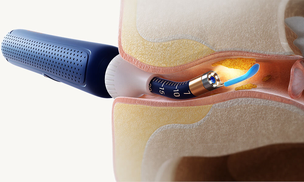 Otoskop do uszu z kamerą BEBIRD Earvision Plus I35R wizualizacja usuwania woskowiny za pomocą jednej z końcówek