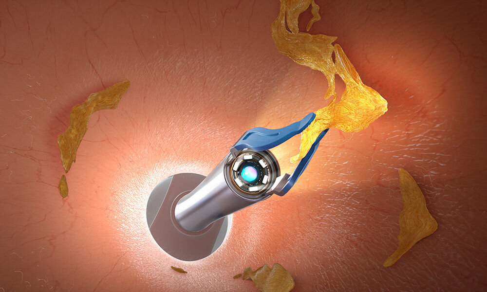 Otoskop do uszu z kamerą BEBIRD Earvision Plus I35R wizualizacja działania pensety wewnątrz ucha usuwanie woskowiny kamera hd