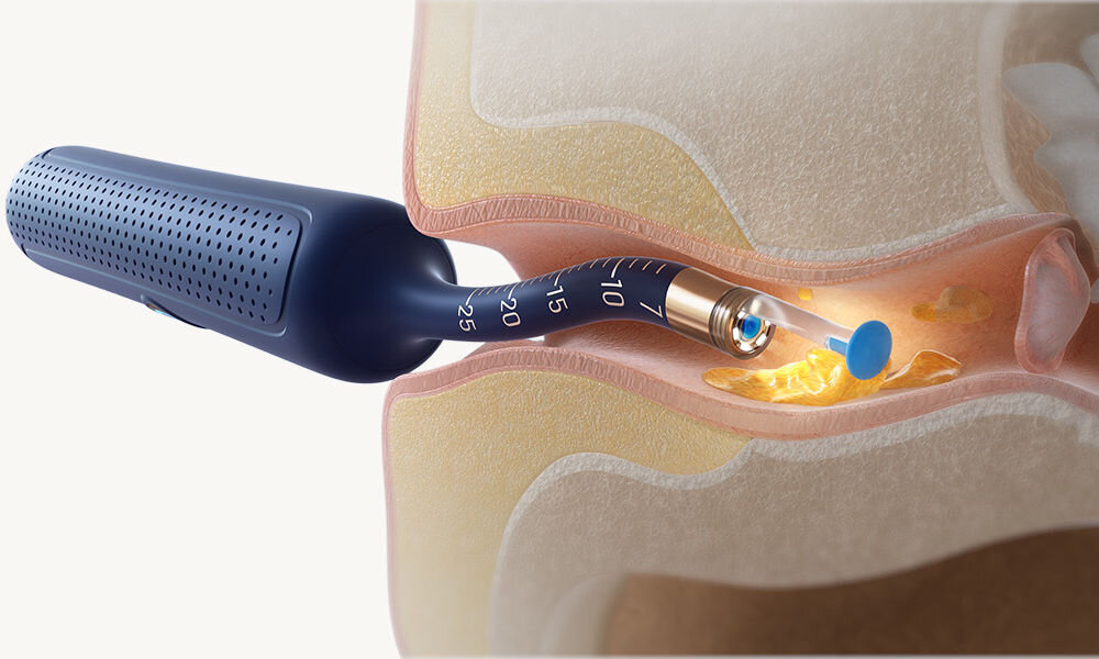 Otoskop do uszu z kamerą BEBIRD Earvision Plus I35R usuwanie woskowiny z ucha za pomocą urządzenia poświetlenie
