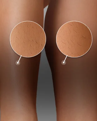 Porównanie: noga po depilacji Silk·épil (0,5 mm) i po wosku (1,5 mm).