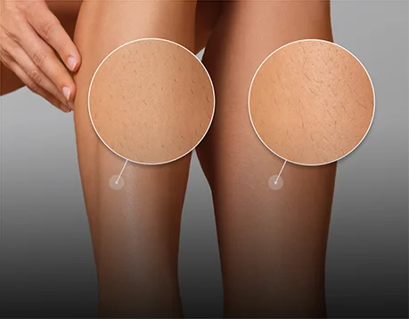 Porównanie: noga po depilacji Silk·épil (0,5 mm) i po wosku (1,5 mm).