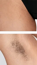 Zbliżenie skóry nogi i pachy z widocznym owłosieniem przed zabiegiem.