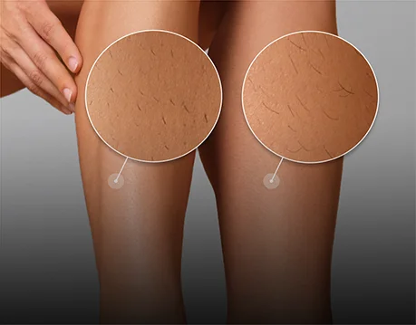 Porównanie: noga po depilacji Silk·épil (0,5 mm) i po wosku (1,5 mm).