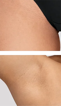 Zbliżenie skóry nogi i pachy z częściowo zredukowanym owłosieniem w trakcie serii zabiegów.