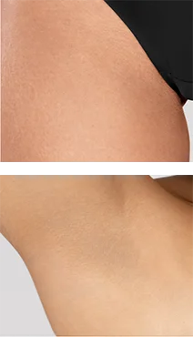 Zbliżenie skóry nogi i pachy gładkiej, bez widocznego owłosienia po zabiegach.