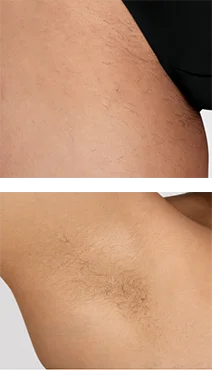 Zbliżenie skóry nogi i pachy z widocznym owłosieniem przed zabiegiem.