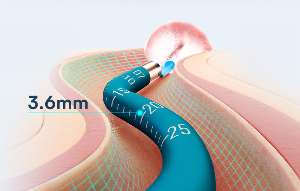 Otoskop z kamerą BEBIRD Earsight Ultra Niebieski Dopasowanie do ucha Elastyczna konstrukcja technologia Flexible Twist Tube Smukła średnica 3,6 mm przetestowana pod kątem wytrzymałości do 1000 zgięć zdjęcie lifestyle prezentacja w uchu