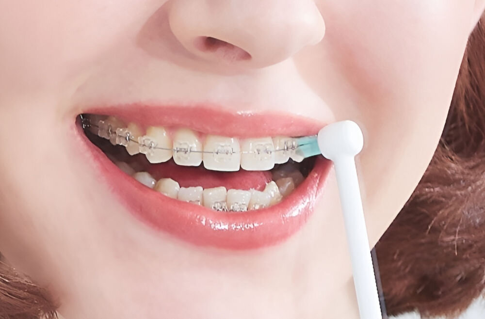 Osoba używa irygatora do czyszczenia zębów z aparatem ortodontycznym. Końcówka irygatora jest umieszczona przy zębach.