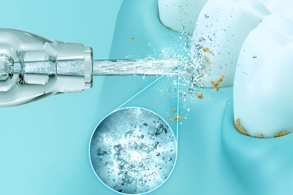 Obraz przedstawia strumień wody z irygatora skierowany na zęby, usuwający resztki jedzenia. W powiększeniu pokazano szczegóły działania wody na powierzchnię zęba.